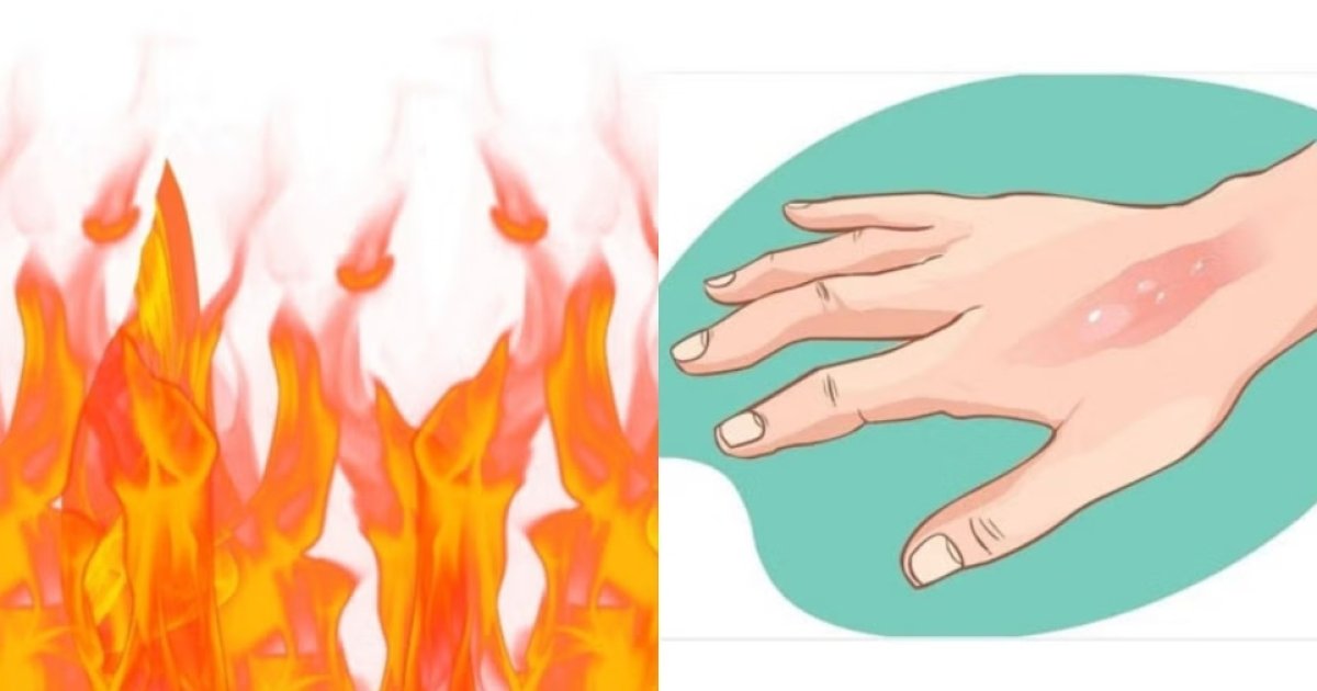 গায়ে আগুন লাগলে সাথে সাথে যে ১০টি কাজ করা জরুরি