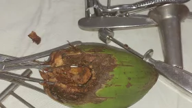 যুবকের পায়ুপথ থেকে বের করা হলো ৬ ইঞ্চি ডাব