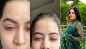 উরফি জাভেদের মুখের এ কি পরিণতি?