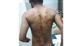 হাসপাতালে কাতরাচ্ছে পিতৃহীন ইয়াসীন, খোঁজ নেয়নি কেউ