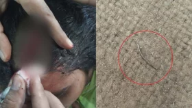 &lsquo;মদ্যপ হয়ে&rsquo; তরুণীর মাথায় সেলাই, রয়ে গেল সূচ