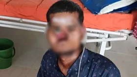 খোকনের ঠোঁট, মাড়ি, তালু, নাক নেই আছে শুধু গর্ত