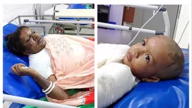 মা-মেয়েকে এসিড নিক্ষেপ করে স্বর্ণের চেইন ছিনতাই