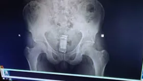 কারাগারে কয়েদির পায়ুপথ থেকে মোবাইল উদ্ধার