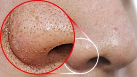 আলু দিয়ে ব্ল্যাকহেডস দূর করবেন যেভাবে