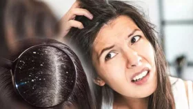 খুশকির সমস্যা সমাধানে জেনে নিন কিছু উপায়