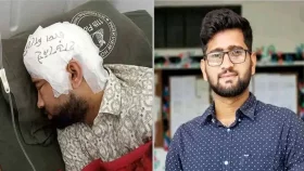 দুই মাস পর চবি শিক্ষার্থী মামুনের মাথার খুলি প্রতিস্থাপন