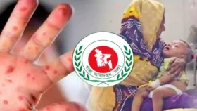 ২৪ ঘণ্টায় হাম উপসর্গে ২ মৃত্যু