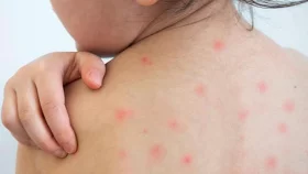 হাম উপসর্গে আরও ৬ জনের মৃত্যু
