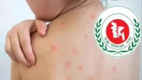 হাম ও হামের উপসর্গে আরও ১১ শিশুর মৃত্যু