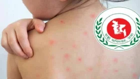 হাম ও হামের উপসর্গে আরও ১০ শিশুর মৃত্যু
