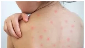 হাম উপসর্গে আরও ৩ শিশুর মৃত্যু