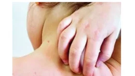 হাম উপসর্গে আরও ৪ শিশুর মৃত্যু